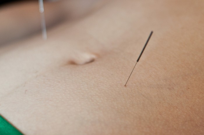 acupuntura marnie joyce